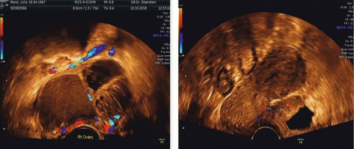 endometriose_abb_4.jpg