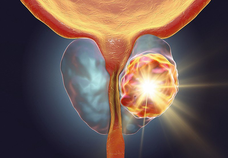 Die Strahlentherapie Eine Sehr Gute Option Beim Prostatakarzinom