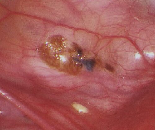 endometriose_abb_9.jpg