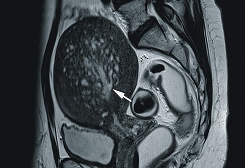 endometriose_abb_6.jpg