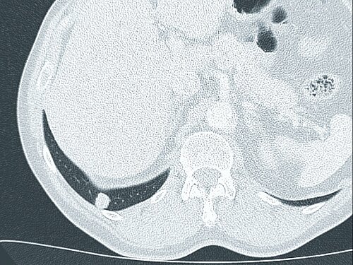 lungenkrebsfrueherkennung_ct_bild.jpg