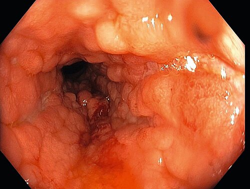 crohn_entzuendungen.jpg crohn_entzuendungen.jpg