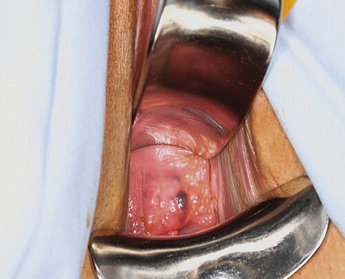 endometriose_abb_3.jpg