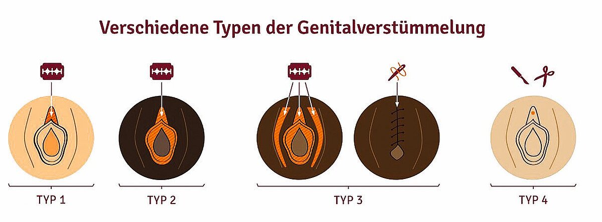 genitalbeschneidung_abb_1.jpg genitalbeschneidung_abb_1.jpg