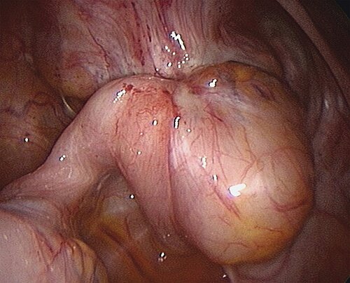endometriose_abb_10.jpg