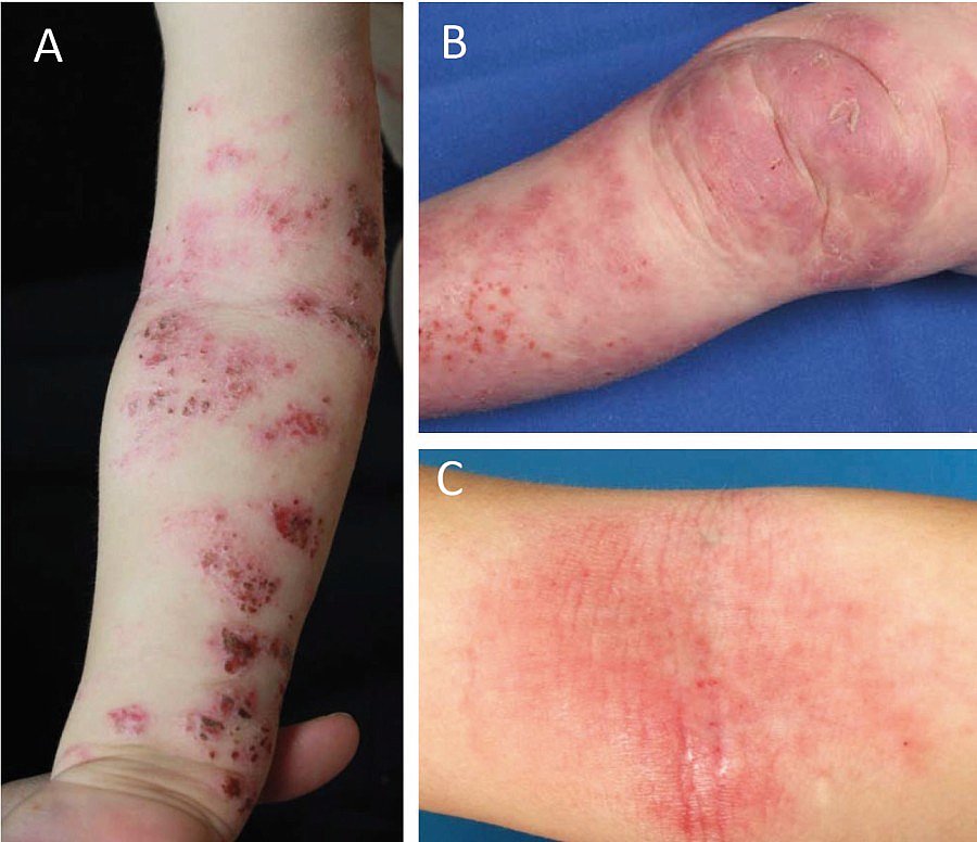 Atopisches Ekzem Landesärztekammer Hessen
