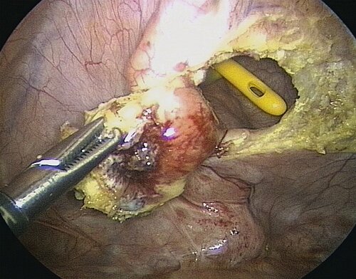endometriose_abb_11.jpg