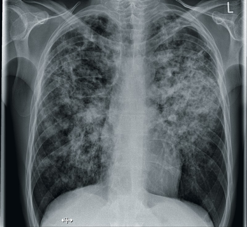 tuberkulose_roentgenbild_thorax.jpg