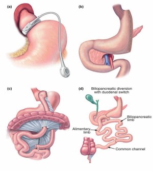 abb_adipositas_kb_jsppt_2_a_d.jpg