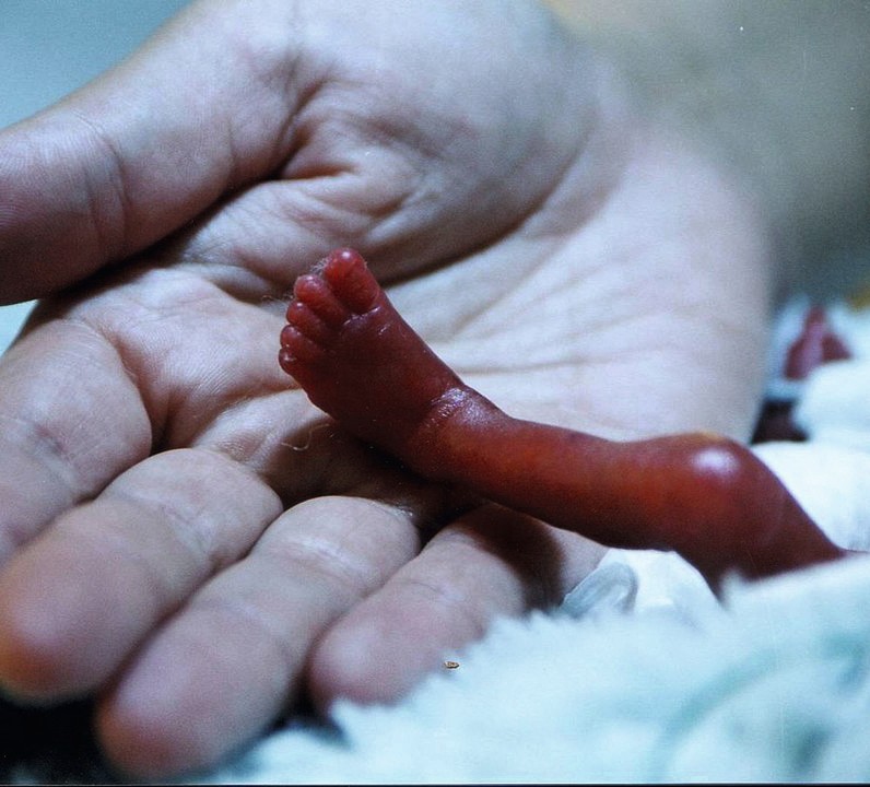 Aufmacherbild CME-Fortbildung Neonatologie